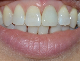 Chan Dental teeth after